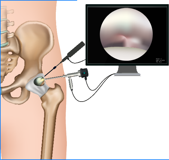 Arthroskopie knie