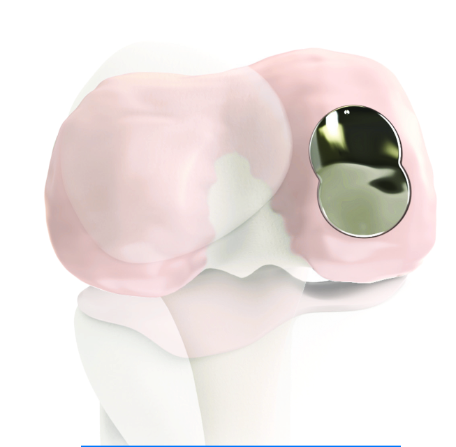 Endoprothese knie hero
