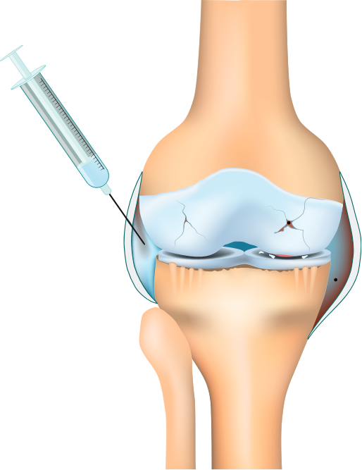 Hyaluronbehandlung